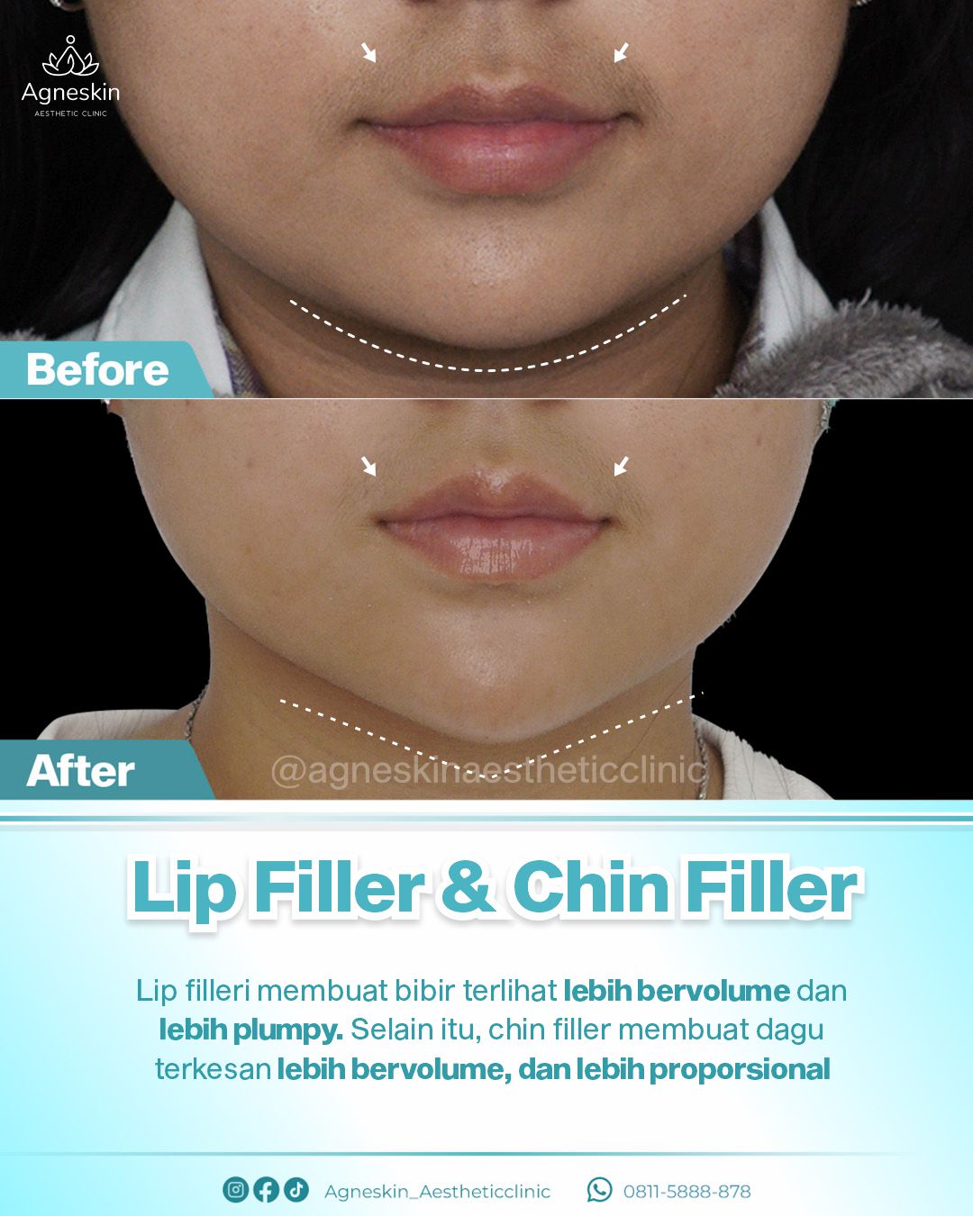 Before After Lip dan Chin Filler